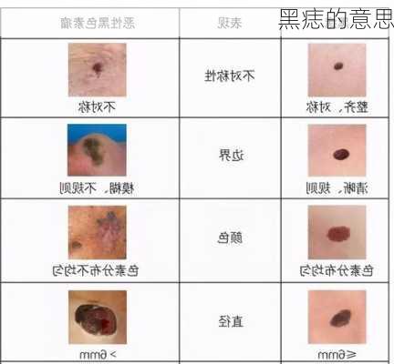 黑痣的意思