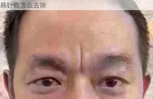 悬针纹怎么去除