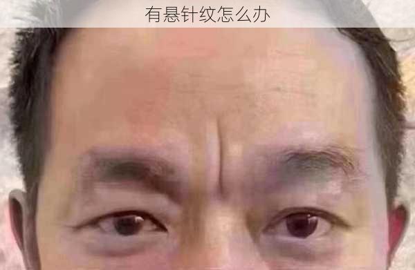 有悬针纹怎么办